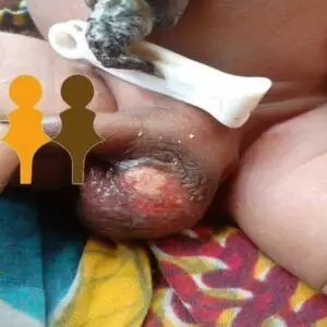 Soutenir un bébé brulé